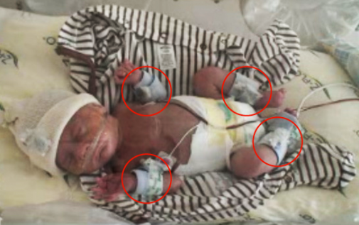 Patterson’s patented limb motion monitor can determine which babies are at greater risk of being diagnosed with cerebral palsy